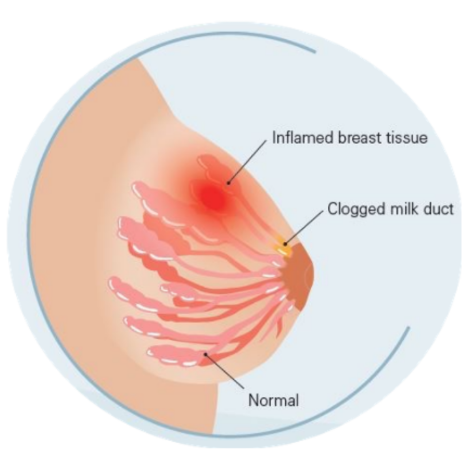 Informativni prikaz žlez dojke v normalnem in vnetnem stanju MASTITIS - what is it? - SquareOne Physio + Pilates + Exercise